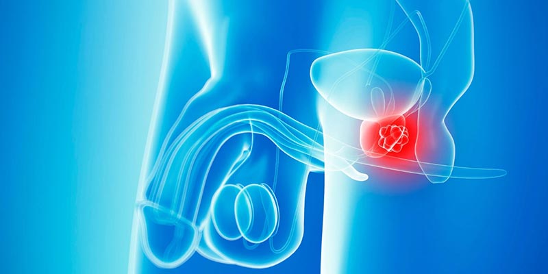 Robotic Radical Prostatectomy