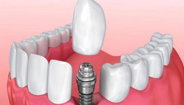 Dental Implant