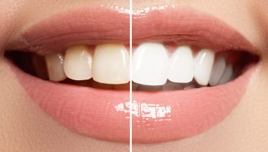 Teeth Whitening - Bleaching