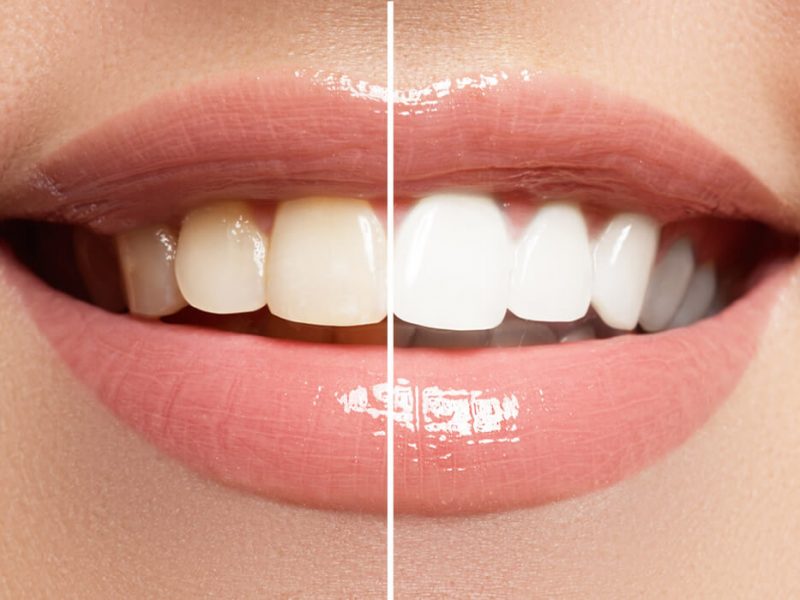 Teeth Whitening - Bleaching