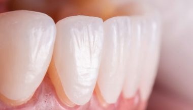 Porcelain Laminated Tooth Veneer