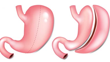 Bariatric Surgery