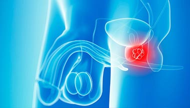 Robotic Radical Prostatectomy