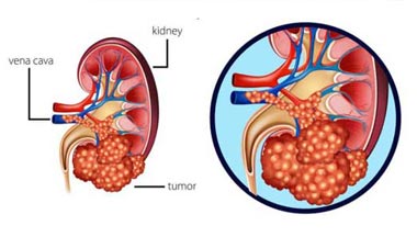 Kidney Cancer Treatment