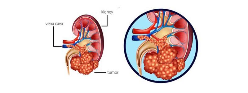 Böbrek Kanseri Tedavisi