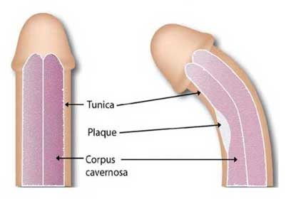 Penis Eğriliği